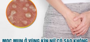 Mọc mụn ở vùng kín nữ có sao không